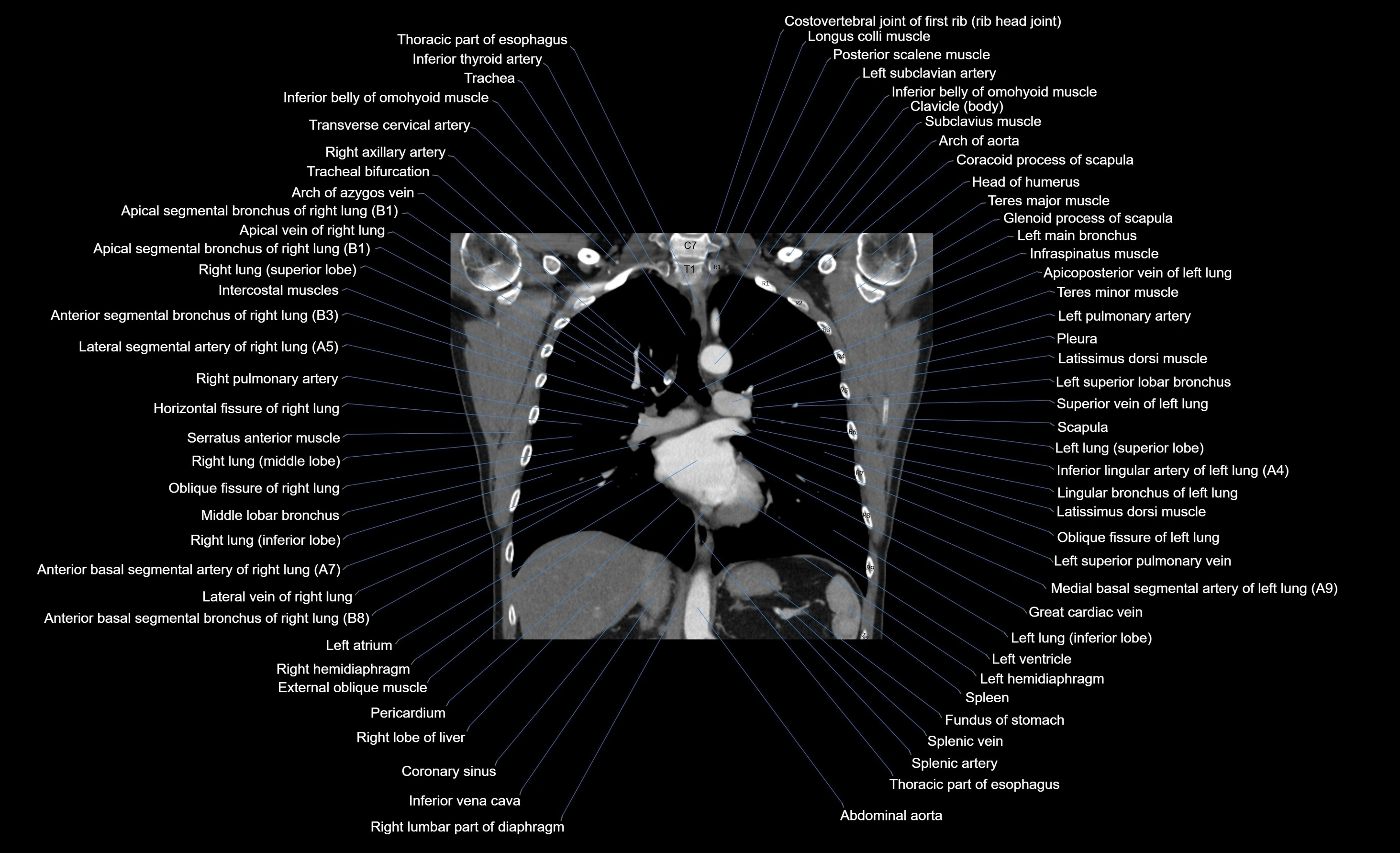 CT chest (thorax) soft tissue window labelled coronal cross sectional anatomy radiology image-00057.webp